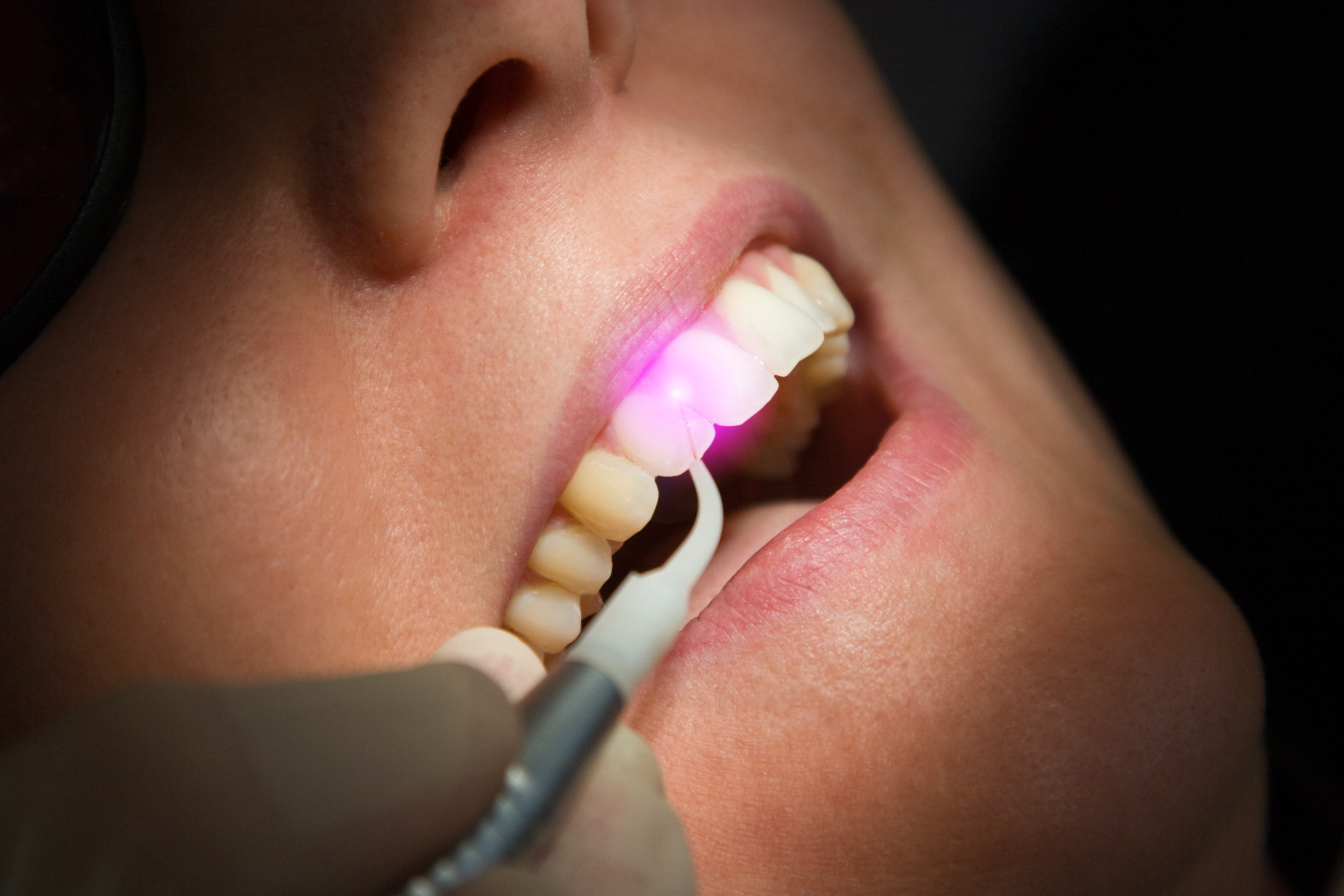 Dental Lasers